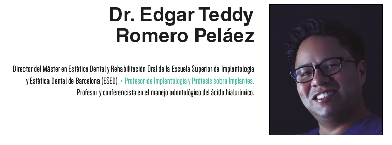 Caso clínico: elevación de seno maxilar y colocación simultánea de implantes con enoinjerto y fijación de membrana con gel de ácido hialurónico