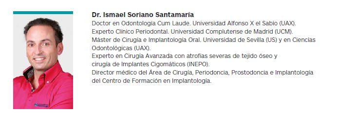 Rehabilitación total en 48 horas con implantes y prótesis definitiva de metal-porcelana