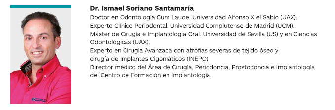 REHABILITACIÓN TOTAL EN 48 HORAS CON IMPLANTES Y PRÓTESIS DEFINITIVA DE METAL - PORCELANA