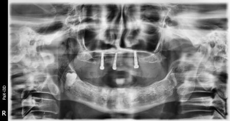 Colocación Implantes Radhex SLD-c parte inferior