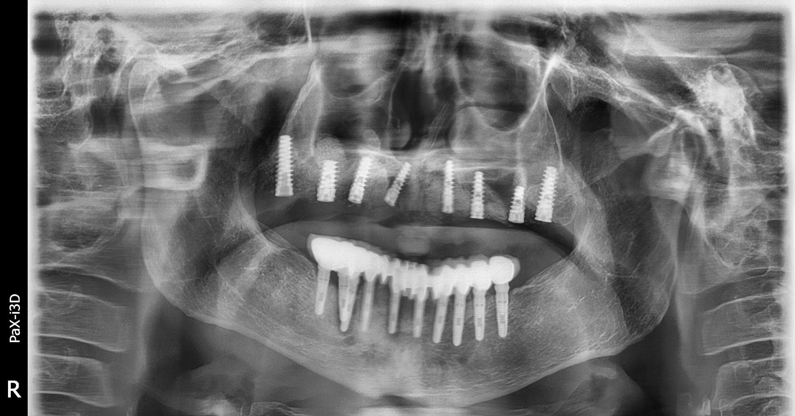 JUAN BUSTAMANTE CON IMPLANTES