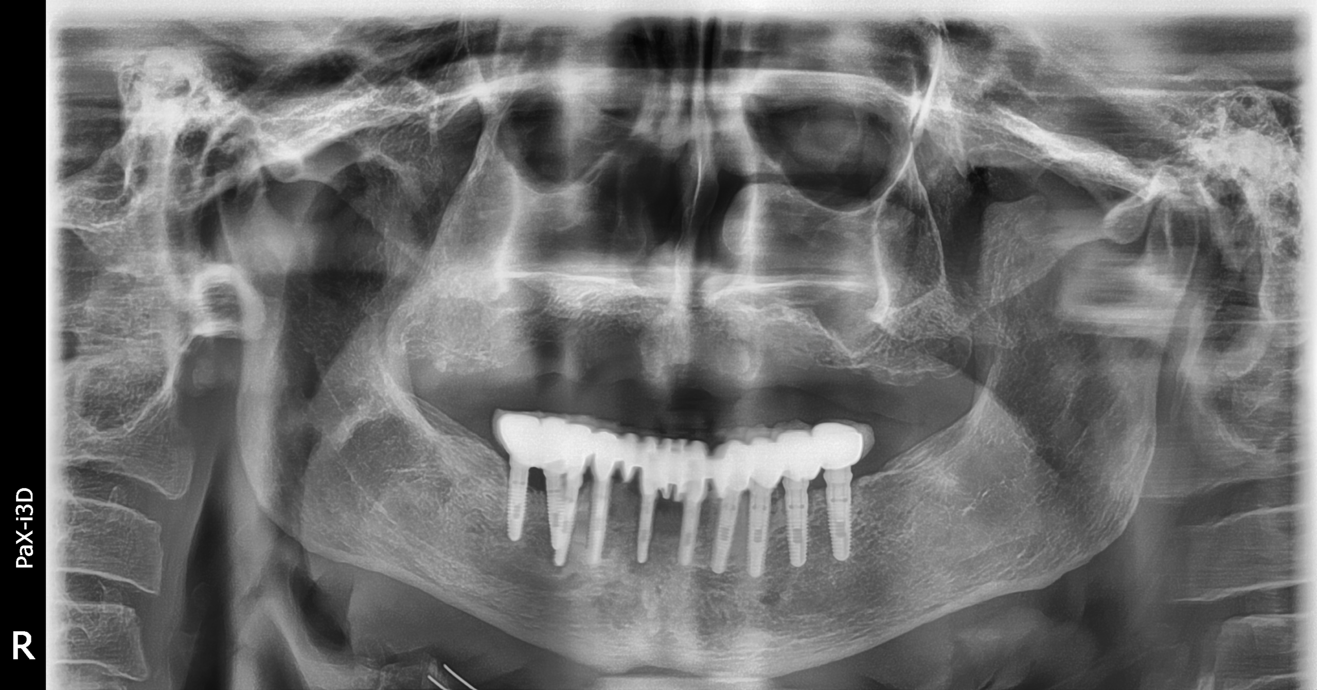 Colocación Implantes PHIA Colocación Implantes PHIA