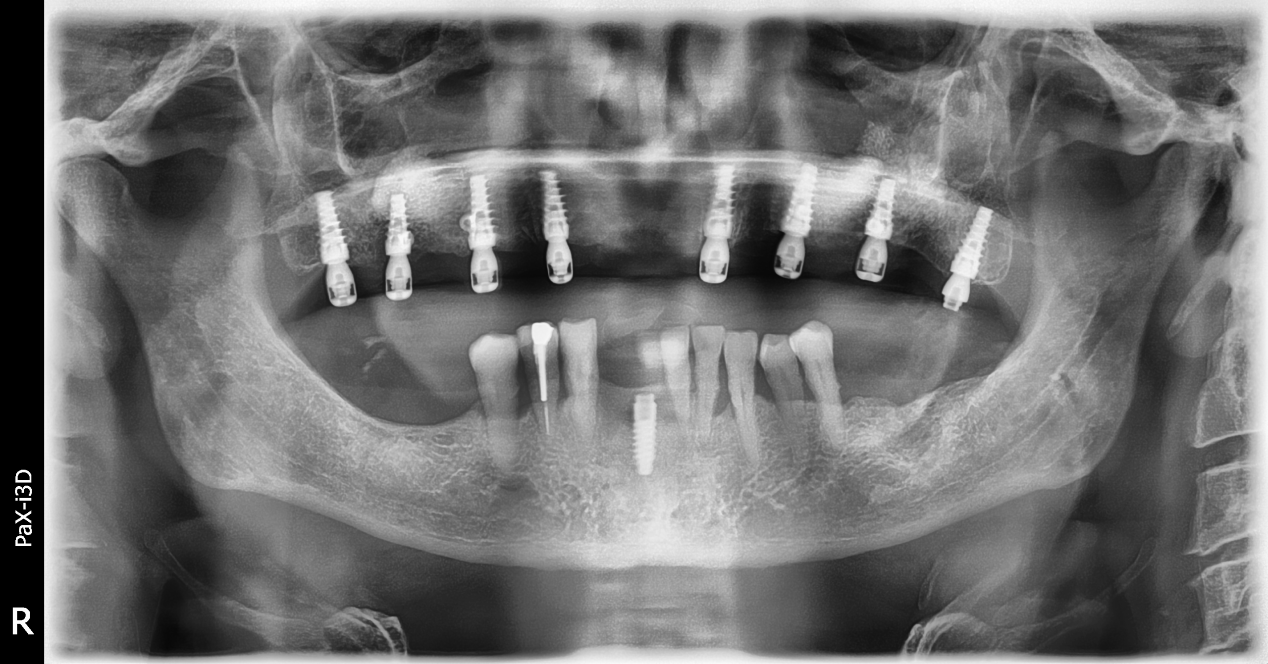 RX Gregorio implantes en max sup