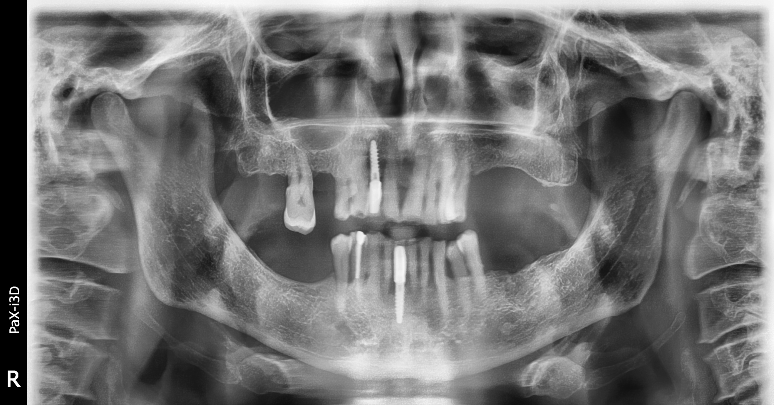 RX Gregorio preliminar