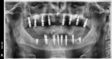 Caso clínico implantes PCI