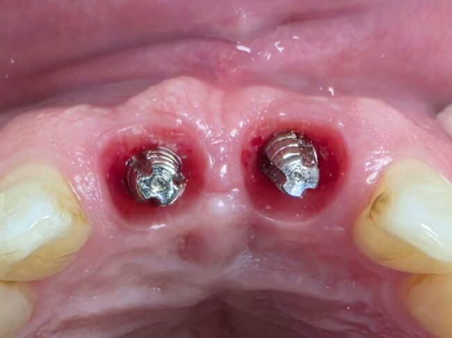 Importancia de los provisionales inmediatos en implantes postextraccion Importancia de los provisionales inmediatos en implantes postextraccion