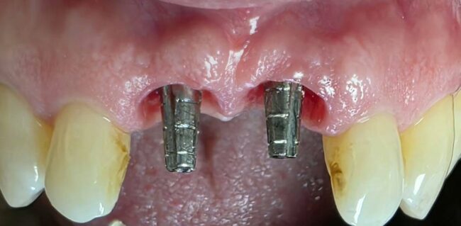 Importancia de los provisionales inmediatos en implantes postextraccion Importancia de los provisionales inmediatos en implantes postextraccion